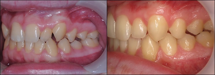Patient 31 before and after orthodontic Invisalign treatment