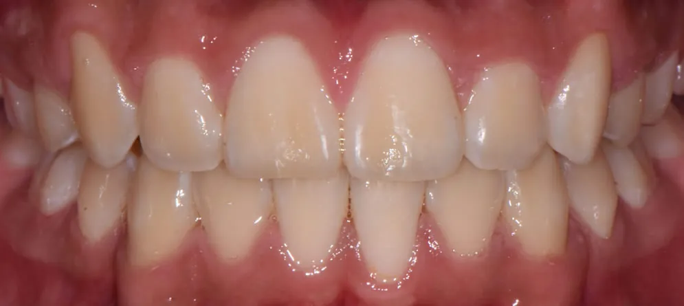 Patient 5 - Teeth with Crowding close up after orthodontic treatment