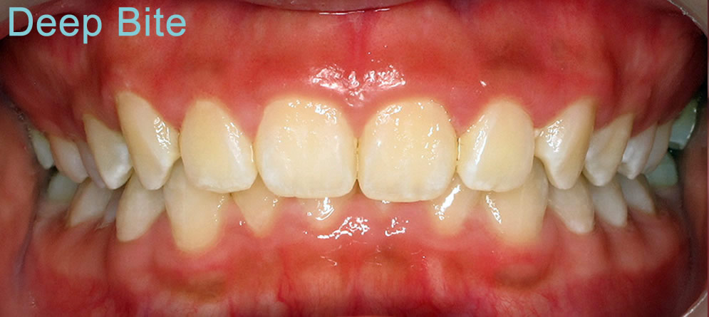 Patient 4 - Teeth with Deep Bite close up before orthodontic treatment