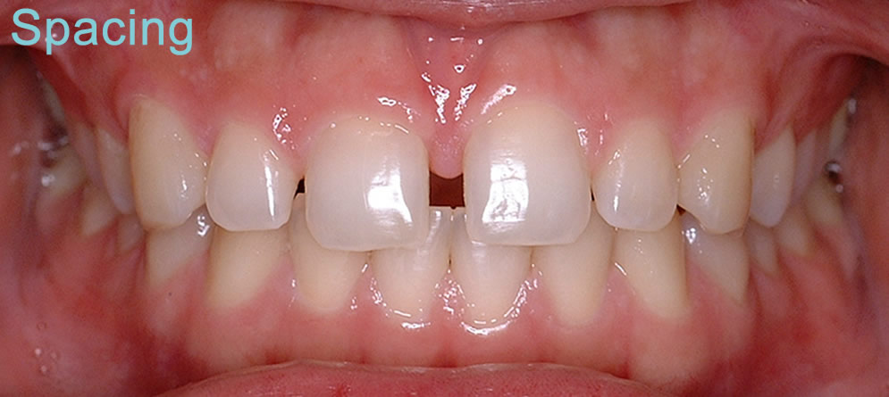 Patient 3 - Teeth close up before orthodontic treatment