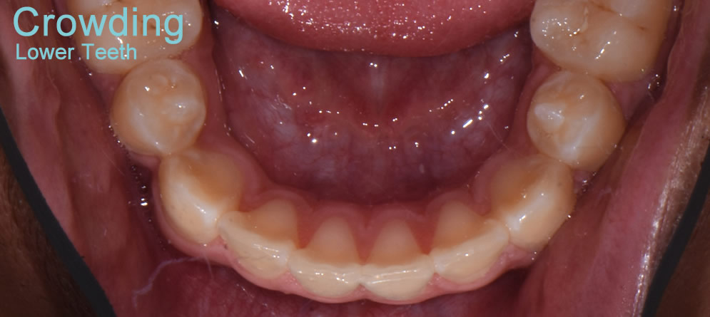 Patient 2 - Teeth close up crowding lower teeth after orthodontic treatment